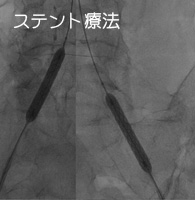 ステント療法