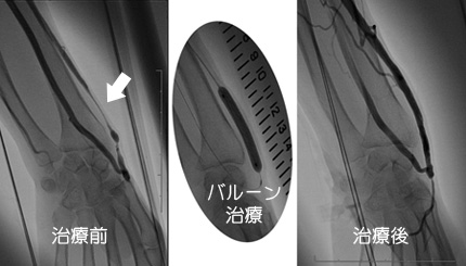 透析シャント治療