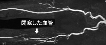 閉塞した血管