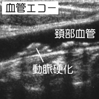 血管エコー
