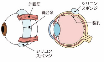 強膜内陥術