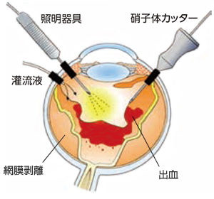 硝子体手術