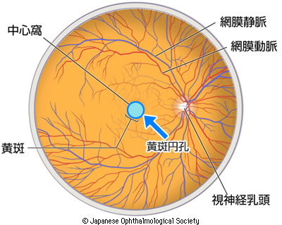 黄斑円孔の症状