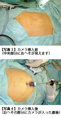腹腔鏡下手術とは 産婦人科 総合女性医学健康センター 産婦人科
