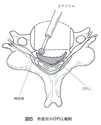 頸椎椎体亜全摘前方除圧固定術