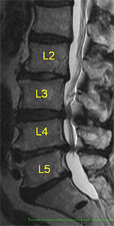 腰部脊柱管狭窄症 症例