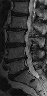 腰部脊柱管狭窄症 症例