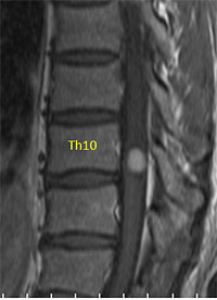 脊髄腫瘍 症例