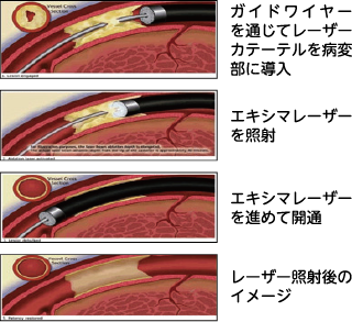 エキシマレーザー冠動脈形成術のイメージ